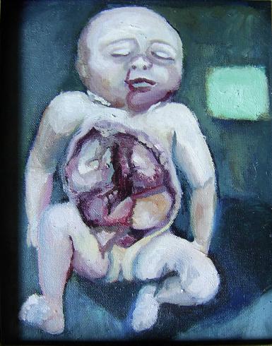 Hernia Diaphragmatica