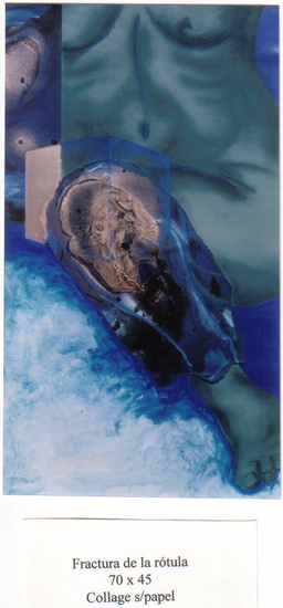 Breuk van het knieschijf